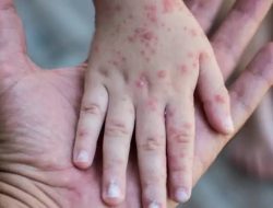 Kemenkes RI: Kasus Cacar Monyet di Indonesia Capai 29 Orang